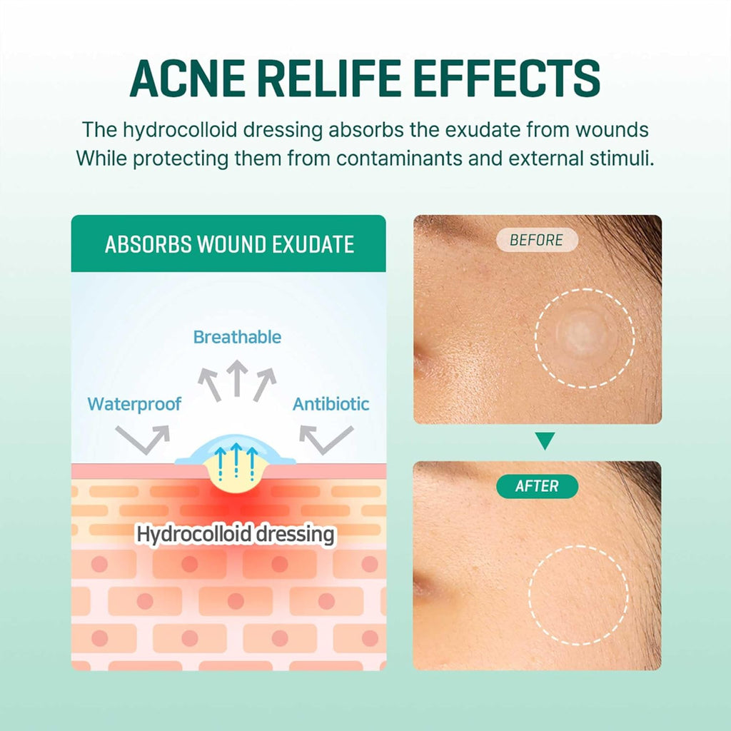 SOMEBYMI – 30 Days Miracle Clear Spot Patch - 18 pcs