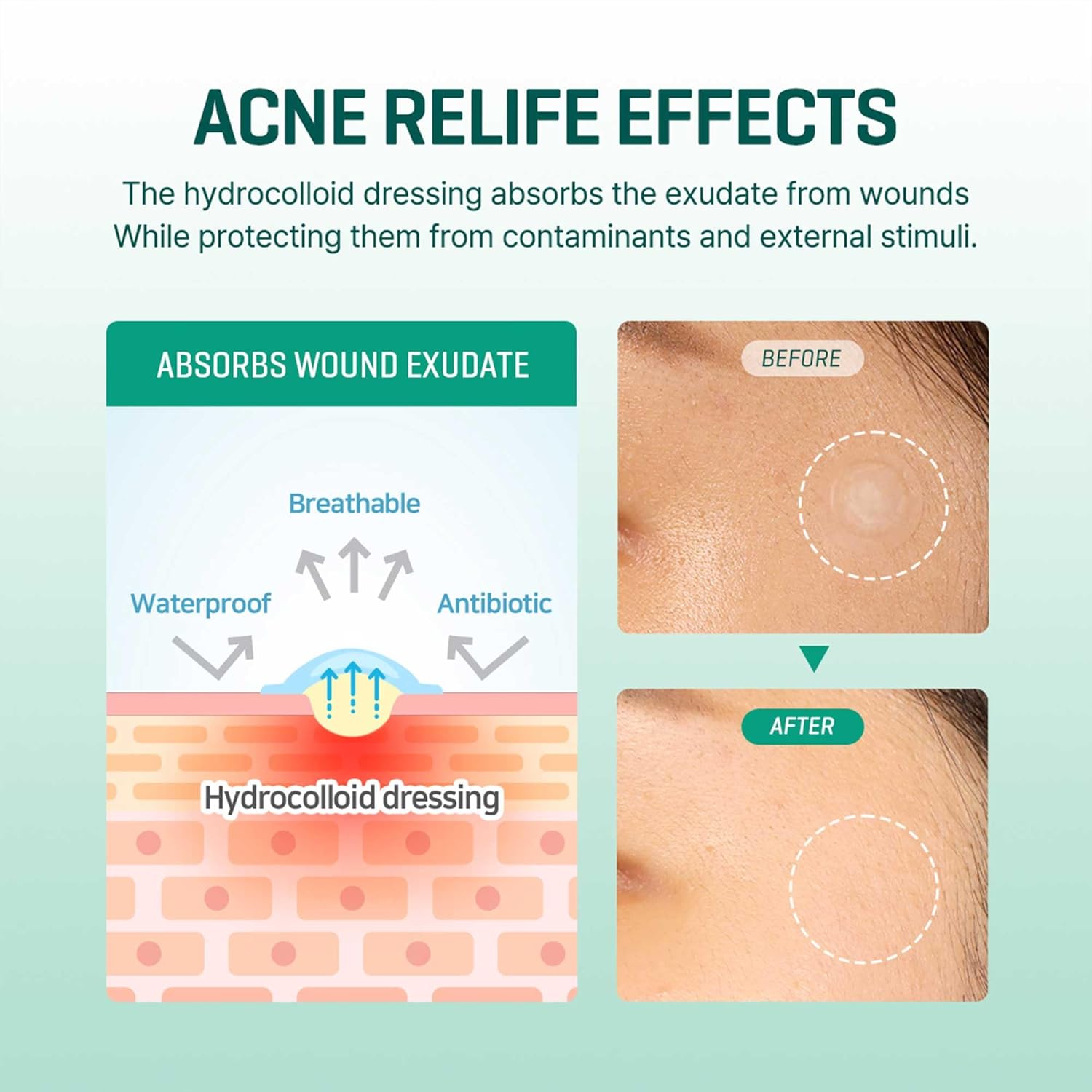 SOMEBYMI – 30 Days Miracle Clear Spot Patch - 18 pcs