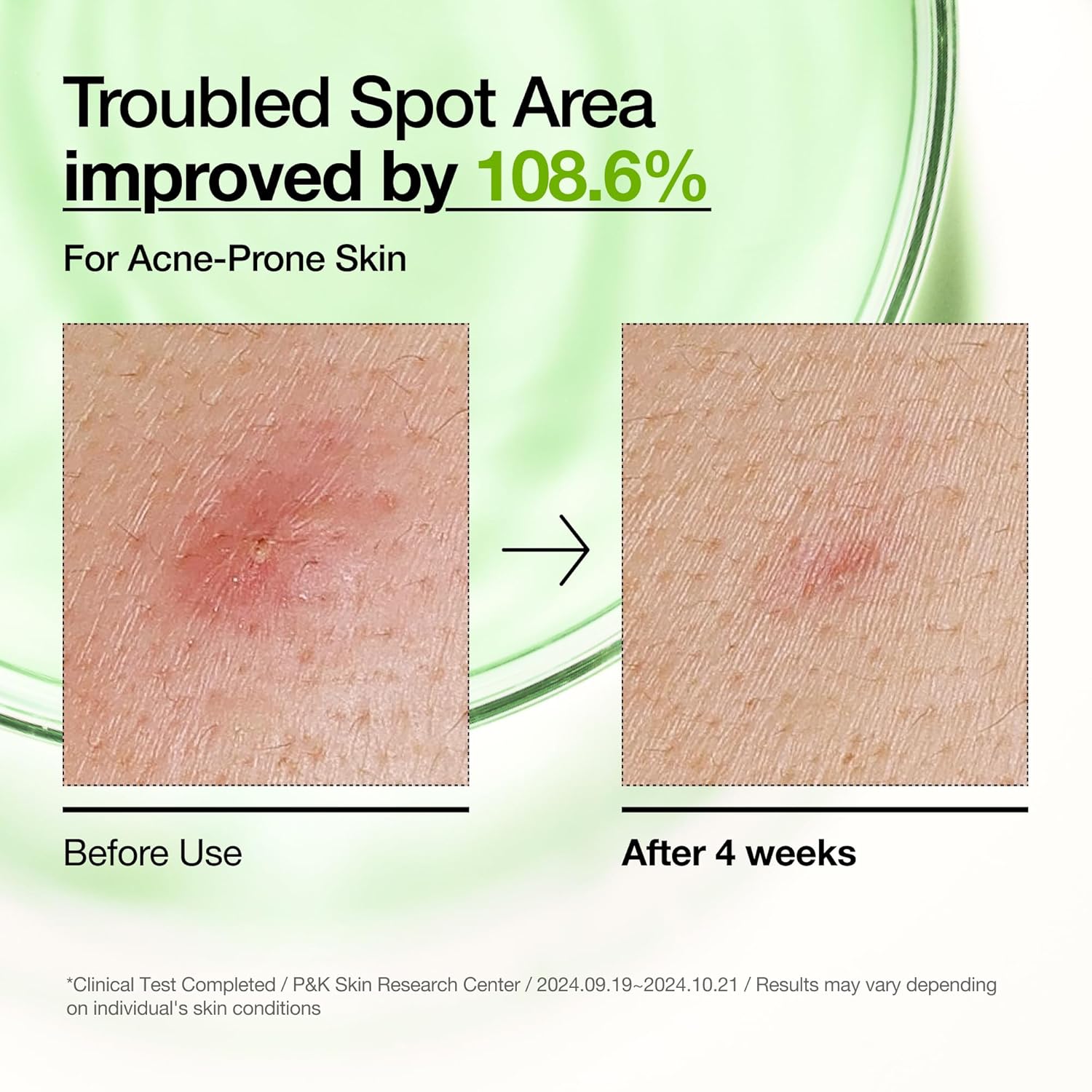 ANUA Azelaic Acid 10 + Hyaluron - 30ml